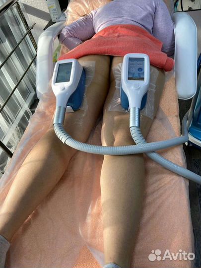 Криолиполиз процедура