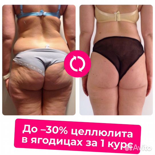 Криолиполиз - убирает жир и целлюлит холодом