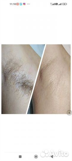 Депиляция воском: глубокое бикини