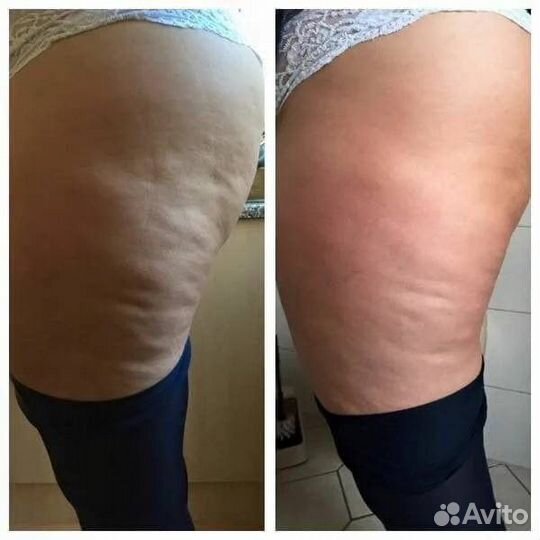 Антицеллюлитный гель от NL