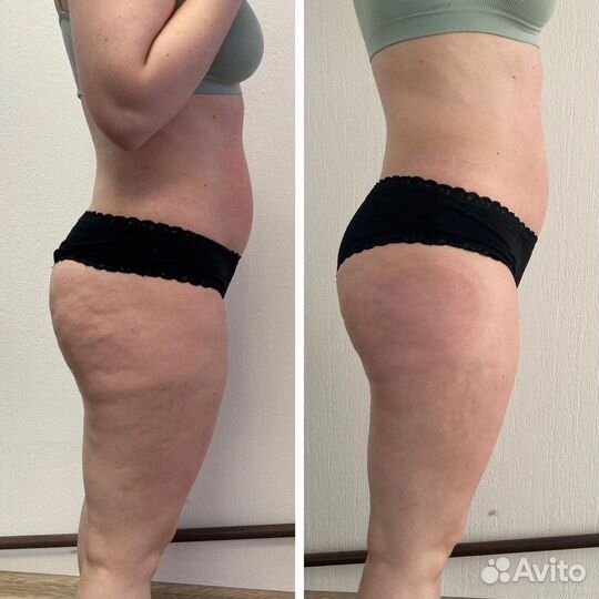 Массаж триггерных точек