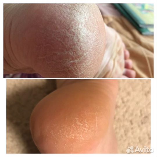 Восстанавливающий крем (псориаз,дерматит и тд)