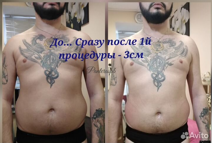 Модель на криолиполиз