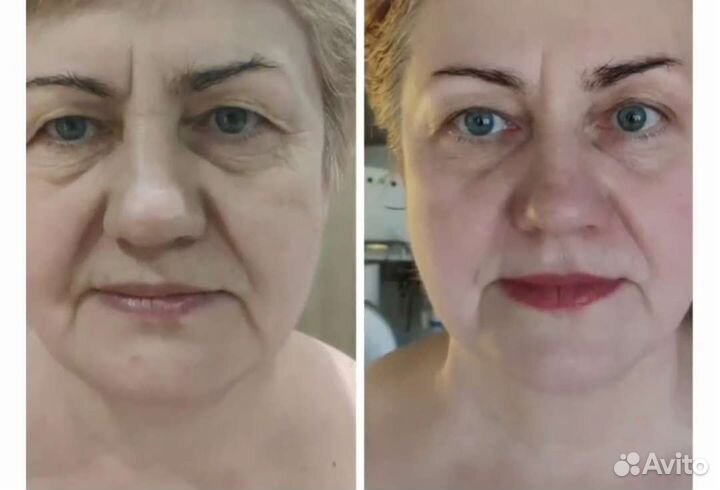 Лимфодренажный массаж