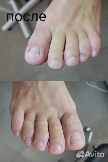 Медицинский педикюр / Подология