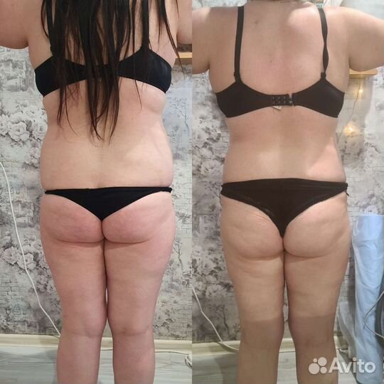 Аппаратная коррекция фигуры: вакуумный массаж