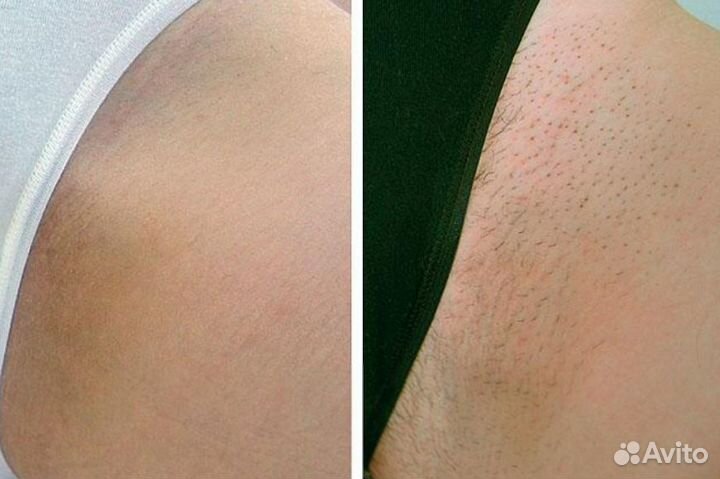 Лазерная эпиляция