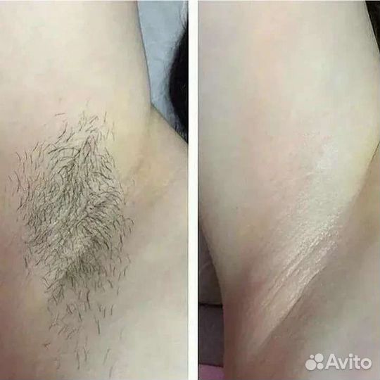 Шугаринг/ Ваксинг