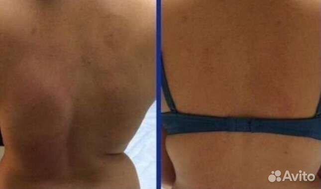 Лечебный массаж спины