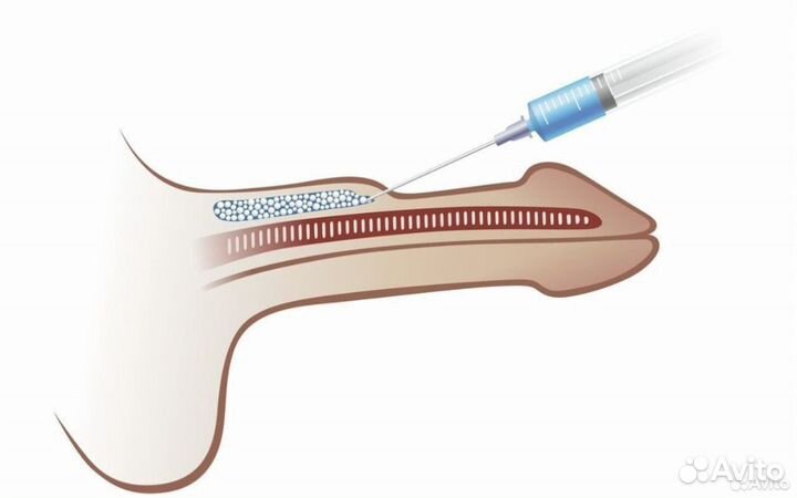 Мужская интимная пластика увеличение члена