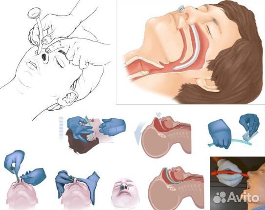 Назальная трубка