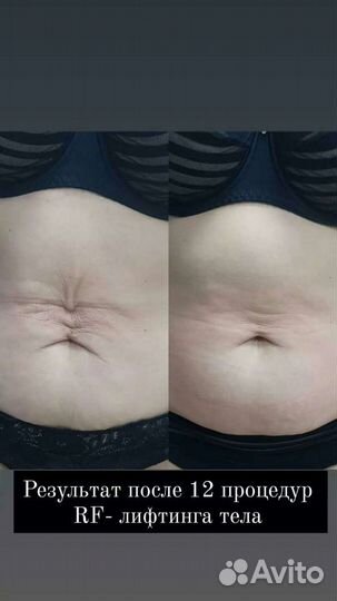 Lpg массаж, Лазерная эпиляция, RF лифтинг и др