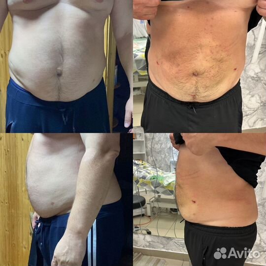 Увеличение губ. Ботокс. Липосакция подбородка