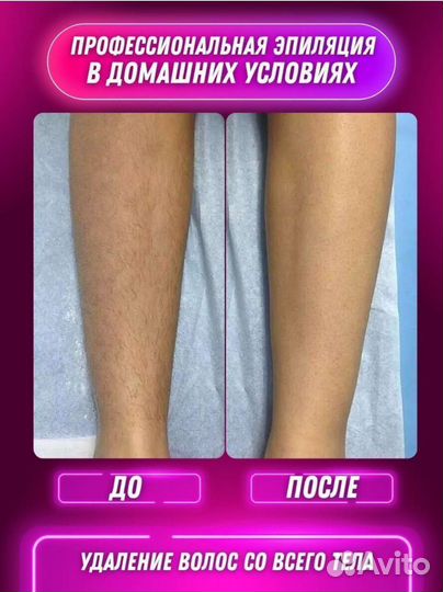 Фотоэпилятор