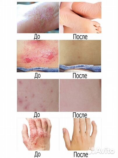 Крем от псориаза дерматита и укусов Yoxier