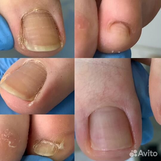 Педикюр медицинский / подолог