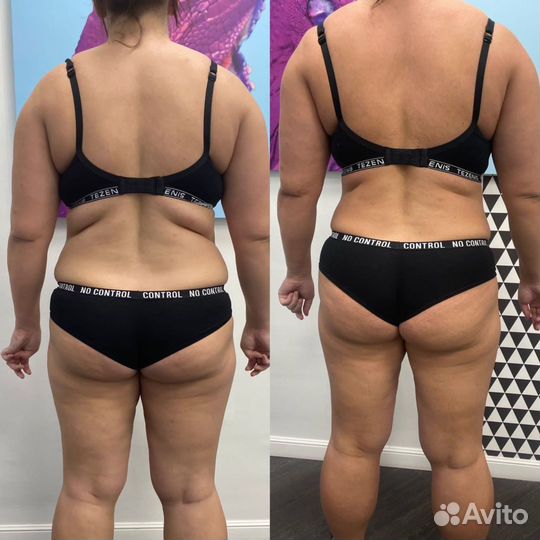 Массаж Vela Shape, круче чем LPG