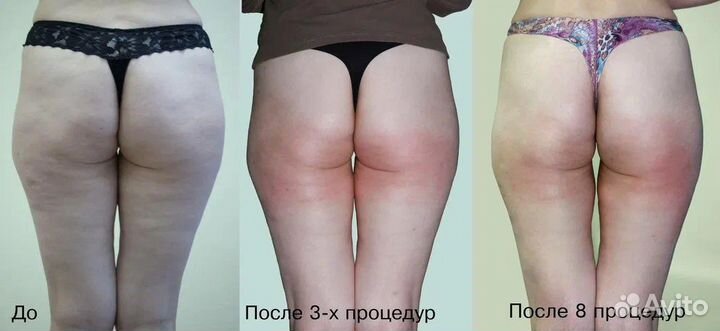 Вакуумный массаж