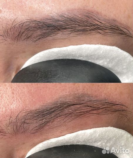 Удаление татуажа татуировок лазером ремувером