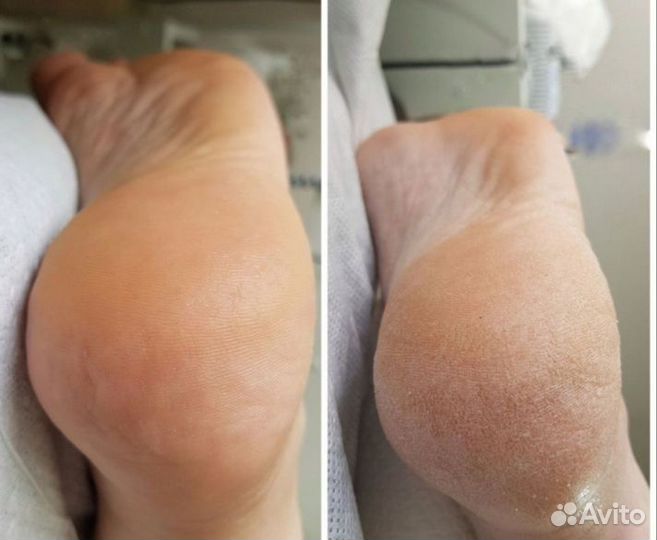 Педикюр гель лак мужской педикюр