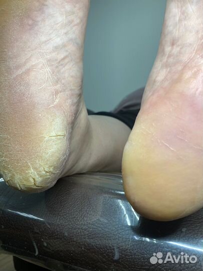 Аппаратный педикюр