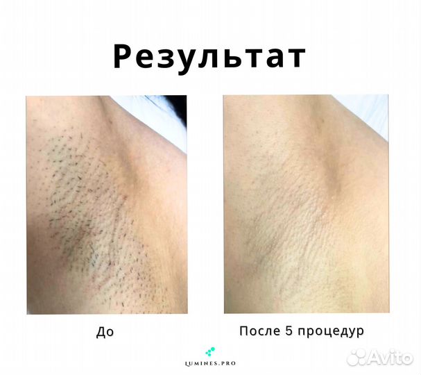 Диодный лазер для эпиляции Лю'Минес MaxOne 1200 Вт