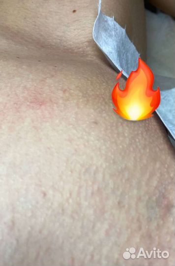 Шугаринг, депиляция