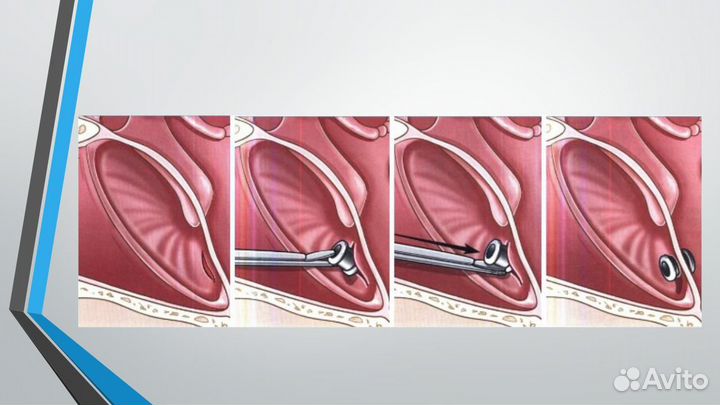 Шунты 2 шт для барабанной перепонки ухо бу