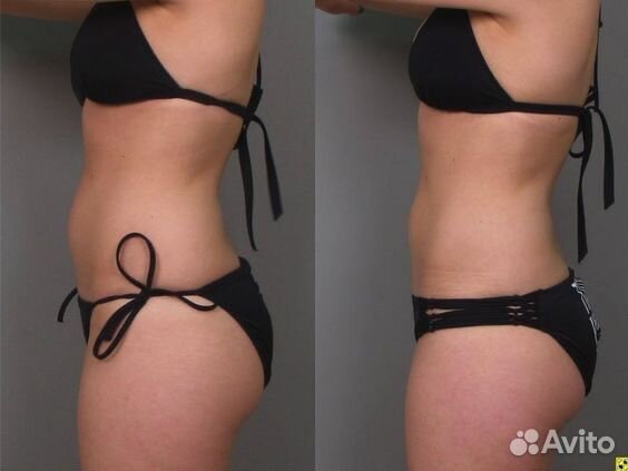 Эффективный Массаж LPG