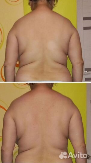 Антицеллюлитный массаж