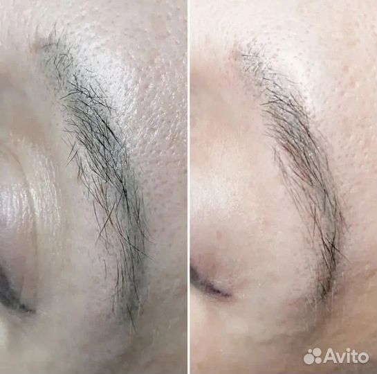 Удаление татуажа ремувером