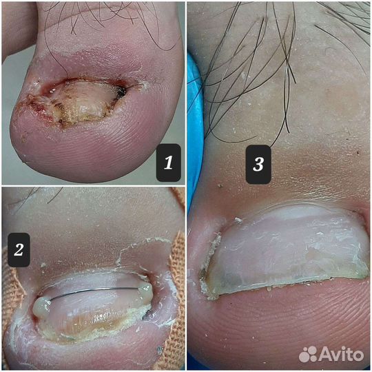 Подолог,педикюр,вросший ноготь