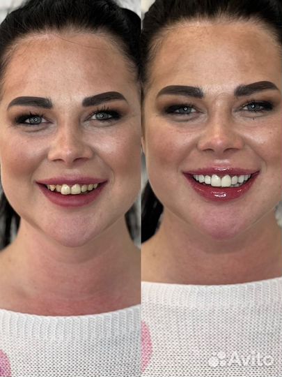 Зубной техник Виниры Коронки