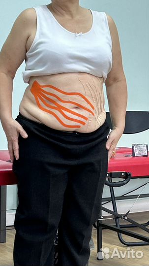 Тейпирование лимфодренажное