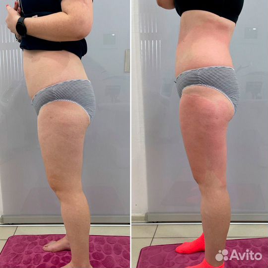 Аппаратный массаж. Коррекция, похудение