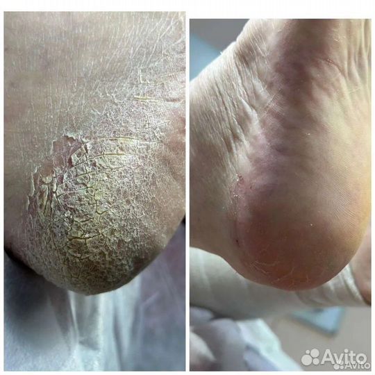 Подолог, smart-педикюр