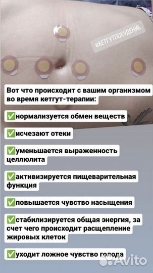 Кетгут похудение