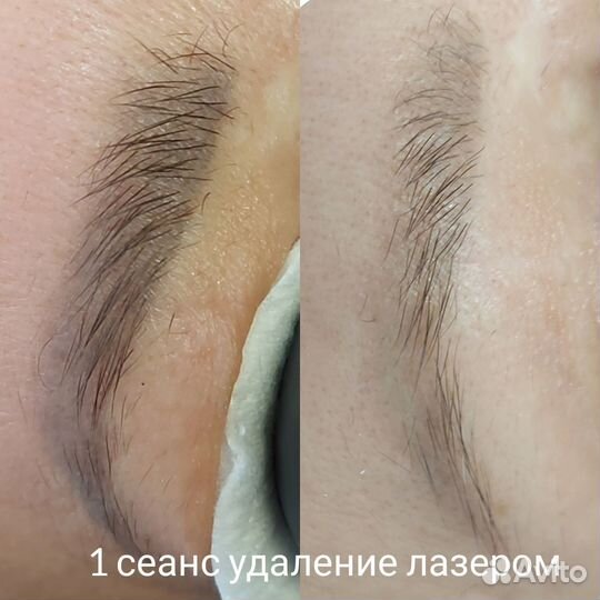 Лазерное удаление тату и перманентного макияжа