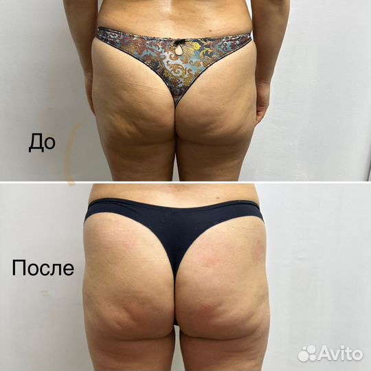 Коррекция фигуры