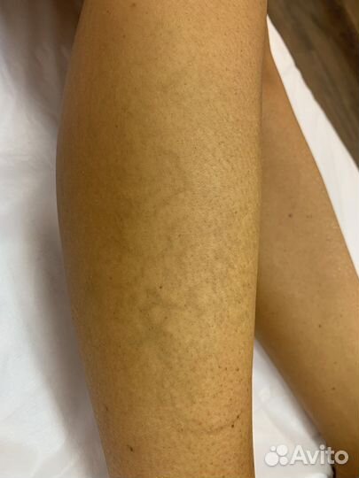 Лазерное удаление татуажа