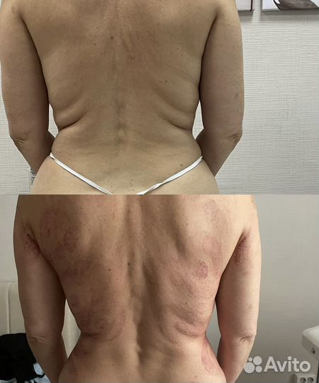 Аппаратный массаж