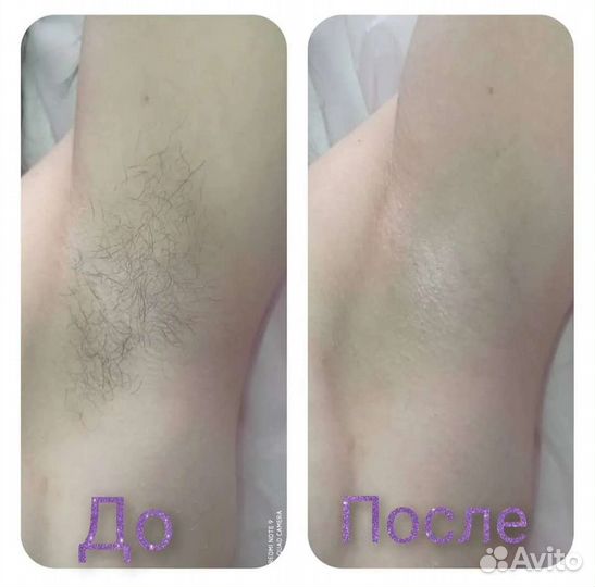 Шугаринг/Воск