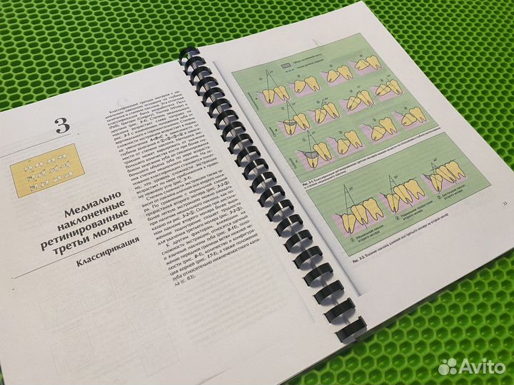 Удаление третьих моляров