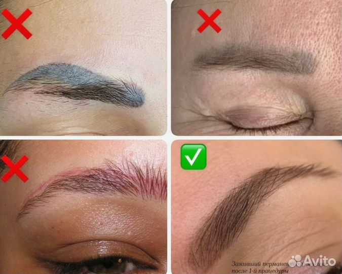 Удаление татуировок