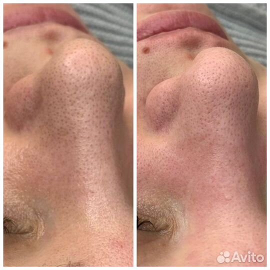 Карбоновый пилинг