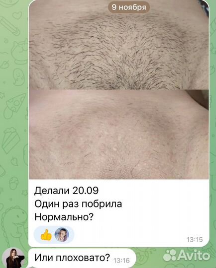 Лазерная эпиляция