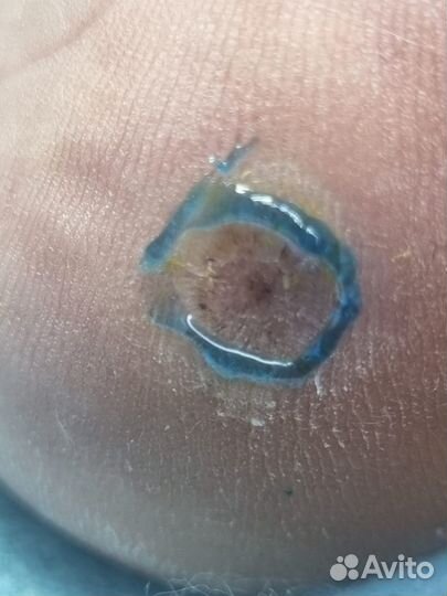 Стержневые мозоли, бородавки, Подолог Липецк