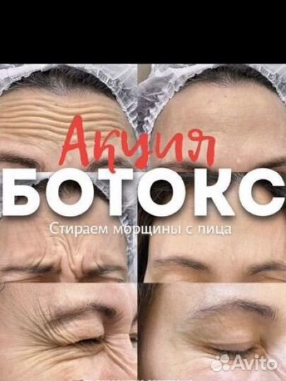 Ботулинотерапия