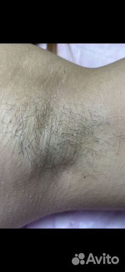 Электроэпиляция - удали навсегда волосы