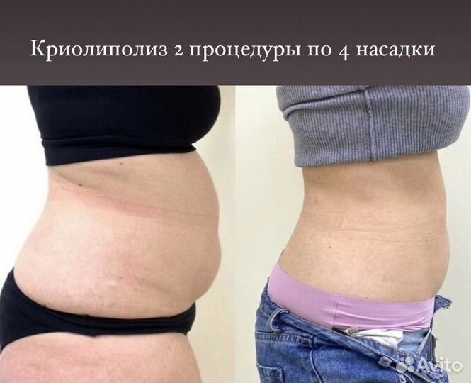 Аппаратный массаж / Криолиполиз / антицеллюлитный